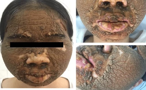 Da "mọc vảy" vì sử dụng thuốc làm trắng không rõ nguồn gốc