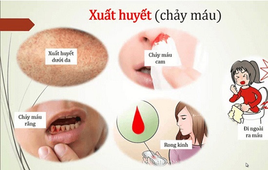 triệu chứng bệnh sốt xuất huyết