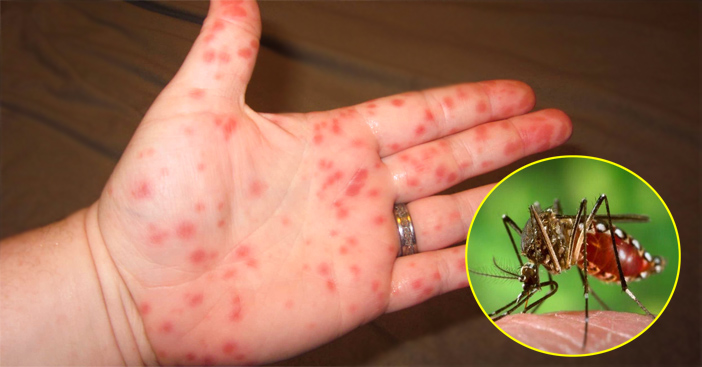 bệnh sốt xuất huyết Dengue là gì?