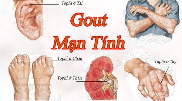 Gout là bệnh gì?