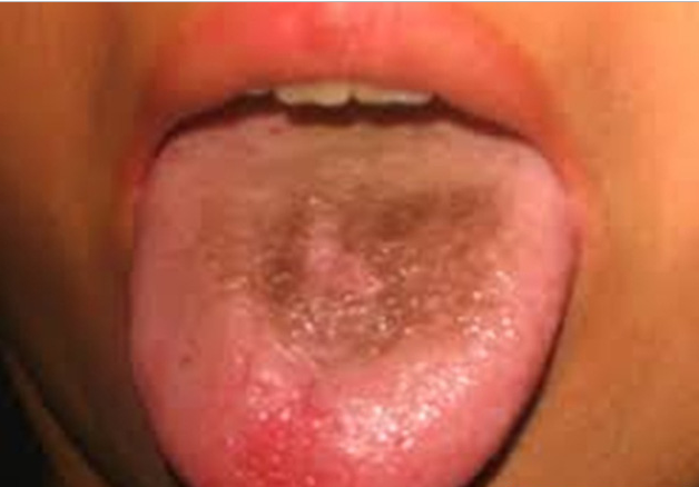 Lưỡi bị đen là bệnh gì? Các bệnh liên quan đến màu sắc lưỡi
