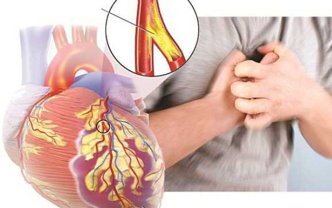bệnh đột quỵ gây ra những biến chứng gì?