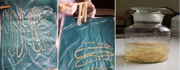 nhiễm ấu trùng sán lợn dây