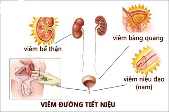 nhung-nguyen-nhan-voem-duong-tiet-nieu-o-nu-va-nam-gioi