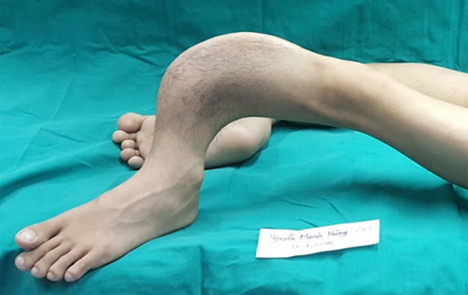 phẫu thuật chỉnh hình chân