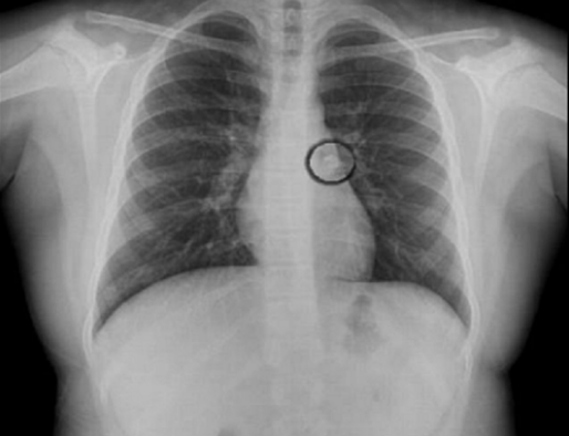 Hình ảnh X-quang cho thấy có một chiếc răng trong đường khí quản của bé gái