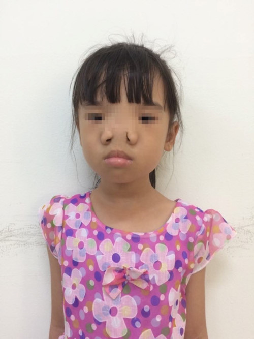 tai-tao-khuon-mat-thanh-cong-cho-co-be-bi-di-tat-hiem-gap