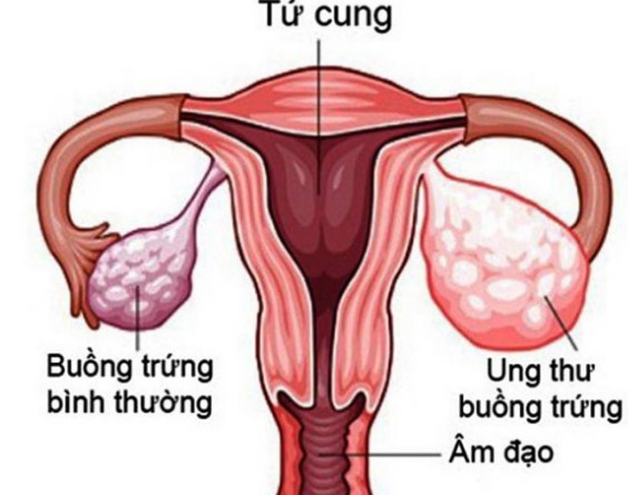 Phẫu thuật ghép buồng trứng giúp tăng cường khả năng có con của những phụ nữ đã qua điều trị hóa chất, xạ trị
