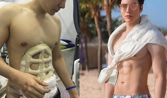 Hàng loạt chàng trai Thái Lan thực hiện phẫu thuật tạc cơ bụng 6 múi
