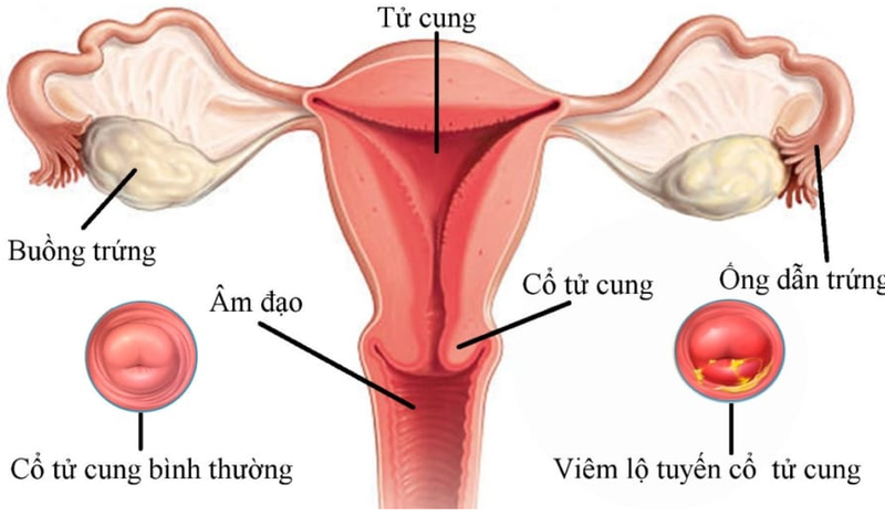 viem-lo-tuyen-co-tu-cung-nguyen-nhan-va-bien-phap-phong-tranh